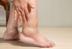 Inchaço nos Pés em Mulheres