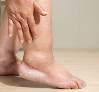 Inchaço nos Pés em Mulheres