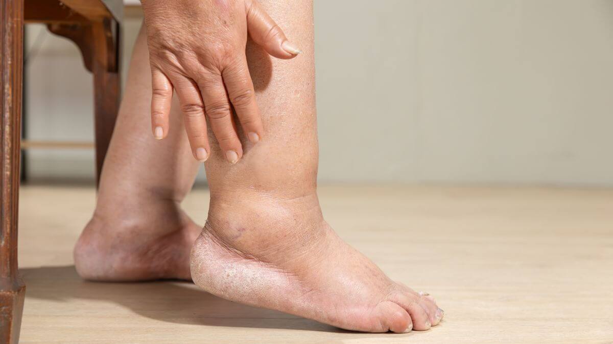 Inchaço nos Pés em Mulheres